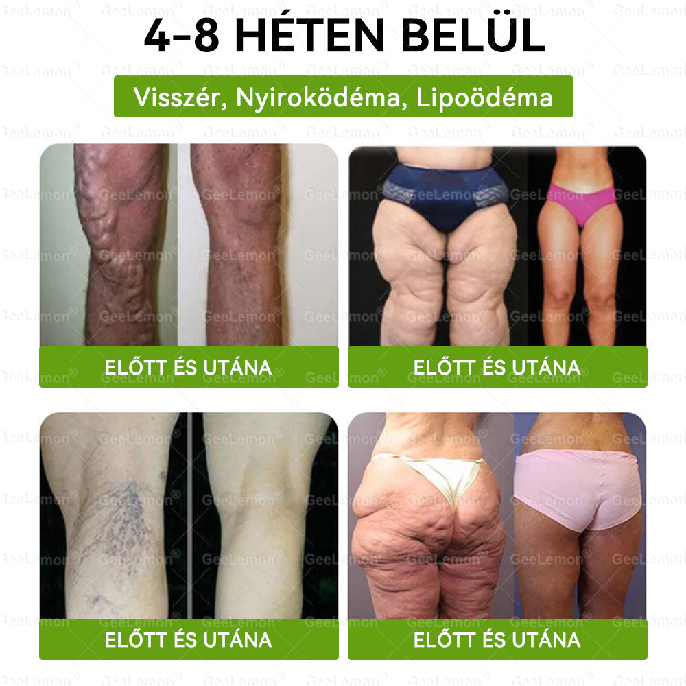 ⚡ Vásárolj 5-öt, kapj 5-öt ajándékba! | Magyar szakértők által ajánlott · 👩‍⚕️ Hivatalos márkabolt | 🎁 GeeLemon® Glumasetide 8 az 1-ben Karcsú és Egészséges Nano Mikrotűs Tapasz 🇭🇺